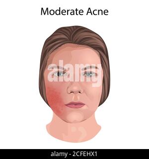 Acné modérée, illustration. Banque D'Images