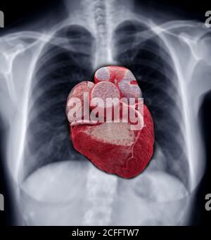 Image de fusion de l'image 3D CTA de l'artère coronaire avec image de radiographie du thorax floue montrant le cœur à l'intérieur de la poitrine pour le concept de vérification. Banque D'Images