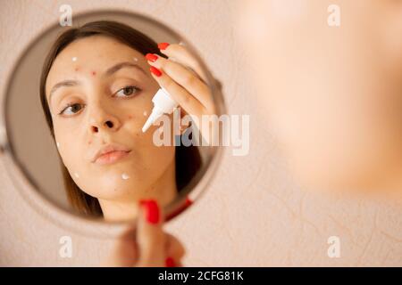 Jeune femme caucasienne applique de la crème contre l'acné et la varicelle de poulet sur son visage, regardant dans le miroir Banque D'Images