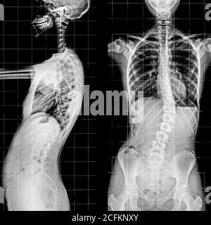 Rayons X de la colonne vertébrale et bassin du squelette humain. Banque D'Images