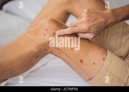 Jambes avec beaucoup de tache rouge et cicatrice de piqûres d'insectes. Allergie aux moustiques. Morsures de mouches de sable Banque D'Images