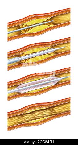 illustration anatomique de la procédure de stent vasculaire Banque D'Images