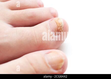 Champignon d'ongle sur le gros orteil du pied Banque D'Images