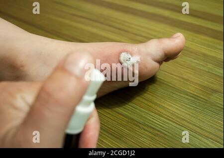 Brûler sur le pied d'un enfant. La plaquette de brûlures a éclaté, cicatrisation des plaies. Traitement de la plaie avec du peroxyde d'hydrogène. Vous pouvez voir le pied de l'enfant, la main Banque D'Images