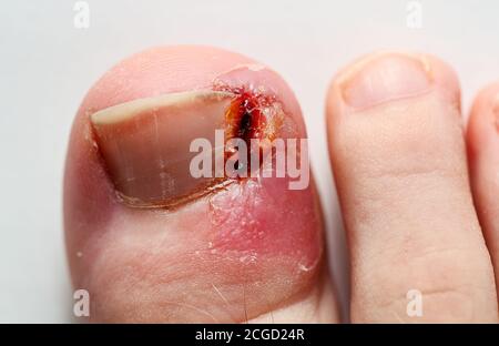 Ongle du pied incarné infecté sur le gros orteil d'un adolescent sur fond blanc. Banque D'Images