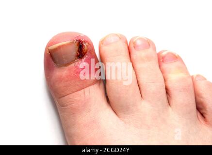 Ongle du pied incarné infecté sur le gros orteil d'un adolescent sur fond blanc. Banque D'Images