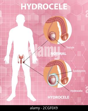 Affiche médicale montrant différents entre le testicule normal mâle et l'hydrocèle illustration Illustration de Vecteur