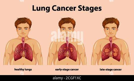 Illustration informative des stades du cancer du poumon Illustration de Vecteur