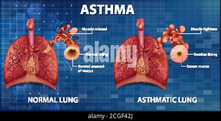 Comparaison des poumons sains et des poumons asthmatiques Illustration de Vecteur