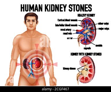 Comparaison des reins et des reins en bonne santé avec des pierres illustration Illustration de Vecteur