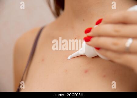 Femme appliquant de la crème sur la peau atteinte de la varicelle Banque D'Images