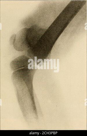 . Principes de l'électromédecine, de l'électrochirurgie et de la radiologie : un traité pratique pour les étudiants et les praticiens. Avec des chapitres sur la vibration mécanique et la technique de la pression sanguine . Plaque XVII Hallux valgus, droite et gauche. Avec l'aimable autorisation de McIntosh Battery and Optical Co. Electro-médecine, électrochirurgie et radiologie 201. Plaque XVIII dislocation epiphyse inférieure du fémur. Gracieuseté de McIntosh Battery and Optical Co. 202 Anthony Matijaca Banque D'Images
