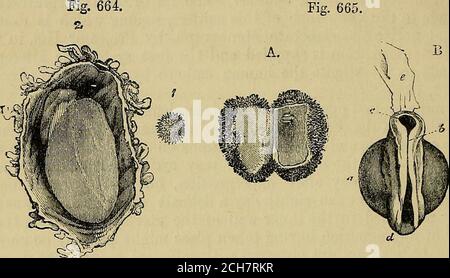 . Les éléments de l'anatomie de Quain . 772 UTEROGESTATION HUMAINE. Ou ^th of an inch. Aucune trace d'anembryon n'a été détectée ; Mais la membrane de l'Otum dont le villositisprang était de structure cellalaire, et au milieu de la partie lisse, se tourna vers l'utérus, là AVAS un point opaque qui pourrait se trahir pour une zone embryonnaire, et qui présenta en interne une couche mince de cellules nucléées finement granulaires. L'ovule se trouve à l'intérieur de la surface postérieure de l'utérus, près de la bordure supérieure, il est incrusté dans la muqueuse ou le décidua épaissi, et il a une fine couche de couverture* Banque D'Images