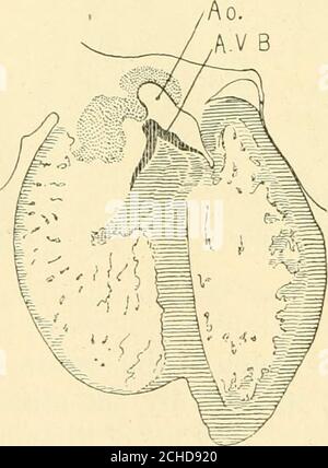 . La revue américaine de l'anatomie . Figure 13 Section sagittale. Embryon de 14 mm de long (XO. 144). X 40.. Figure 14 Section coronale. Embryon de 17.2 mm de long (n° 424). X 24. Autres deux embryons (fig. 12). L'ouverture est progressivement réduite dans les embryons suivants, dans l'ordre de leur énumération, n° 423 (15.2), 144 (14, fig. 13), 424 (17, fig. 14). Dans 390(15.5), il est incertain qu'il soit fermé ou non, dans 409 (16) il s'agit DU DÉVELOPPEMENT DU COEUR HUMAIN 271 juste fermé, et dans 432 (18) il est fermé mais sa connexion avec le ventricule de la lumière est toujours indiquée. Que l'ordre de developpementne fait pas Banque D'Images