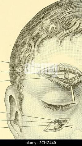 . Texte-livre de chirurgie opératoire . ed c'est la règle même quand l'antre a été ouvert. (6) des branches du ganglion sphéno-palatin, seuls les nerfs palatin peuvent être attaqués séparément. Ils peuvent être injectés dans le voisinage du foramen de largerpalatine afin de produire des ansesthesia devant et à l'intérieur du processus théhamulaire. 224 CHIRURGIE OPÉRATIVE (c) troisième {Macillavy inférieur) Division du nerf trijumeau. (Fig. 108.)la troisième division du nerf trijumeau consiste, au niveau du foramen ovale, en parties motrices (postériorly et externaUy) et sensorielles si intimement u Banque D'Images