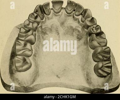 . Techniques d'anatomie opératoire et dentaire; manuel de classe et de laboratoire pour les étudiants en médecine dentaire de première année . Figure 223.—modèle élargi en aluminium utilisé par l'auteur pour l'enseignement de l'anatomie dentaire. Les modèles agrandis de formes de dents naturelles sont précieux pour l'enseignement de l'anatomie dentaire et ceux-ci, avec la prép-arations typiques de cavité, et les plombages amovibles, sont d'un grand service dans le cours technique d'opération. Le plan d'appeler les étudiants de la classe pour souligner certains points d'intérêt sur ces formes en-grands fonctionne bien. À Northwestern University DentalSchool est un ensemble, sculpté dans le bois, beaucoup de fois agrandi, un Banque D'Images