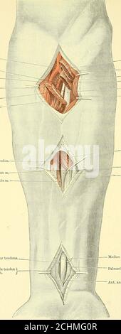 . Livre de texte de chirurgie opératoire . g au point d'intersection de ces ficelles. Après division de la peau, le fascia superficiel (qui est offen d'épaisseur considérable), et le fascia palmar aponeurotique fort, l'arche est à onceexposé incrusté dans la graisse sous la surface lisse de ce dernier. L'archis la continuation de l'artère ulnaire, et à ce point il courbe vers l'extérieur towardsle pouce. Les artères numériques communes passent vers le bas de l'arche. La recherche repose sur les branches numériques des nerfs médians et ulnaire, ces derniers étant exposés. Si l'artère ne peut pas être FO Banque D'Images