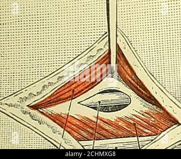 . Texte-livre de chirurgie opératoire . artère de la promunda, artère sous-capsulaire, médiane, sous-capsulaire, musculospiral, et nerfs cirflex. CHIRURGIE DES GRANDES ARTÈRES 117 brachialis muscles qui descendent sous le pectoralis majeur sont exposés et drawninwards. L'artère est vue entre les deux têtes des biceps, en cours de transverselyin un peu de graisse juste en dessous de la tête de l'humérus et au-dessus de l'Insertiondu pectoralis majeur. 29. Ligature de l'artère circonflexe postérieure (Fig. 46). Si la bordure postérieure du muscle deltoïde est poussée vers le cou chirurgical de l'humérus, l'angle W Banque D'Images