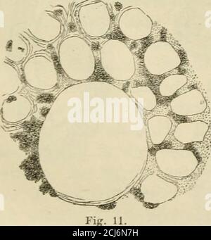 . Handbuch der speciellen Pathology und Therapie . ngen der Harnkanälchen mit neu gebildeten Epitelzellen besetzt. La néphrite de Chronisch-pivochymatöse. (Colberg.) Colbergsehen Zeicnung nachgebildet, illustriren dieses Verhält-niss. Die Verbreitenmg der intertubulären Grundbeelz ist theilsdurch Quellung derselben mit flüssigem Exsudat, theils durch ent-zündliche Wucherung der vorhandenen Bindegewebselemente, theils endlich durch Einwanderung zahl-weisser Blutkörloss-kt. Die letzteren verdeawn theil-weise einer fettigen métamorphose;es bleibt von diesen fettig zerfallenZe Banque D'Images