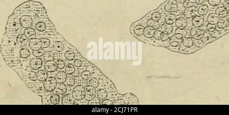 . Handbuch der specellen Pathologie und Therapie . ,^ f::^: Fig. 3.Dunkelköniige Cylinder aus dem Urin bei secundärer Nierenschtrumpfung. Anhängsel,wie Epithelialzellen aus den Harnkanälchen oder Trümmer,vereinzelte weisse oder rothe Blutkörperchen, Niederamorphe schlägevon Harsauren Salzen, Krseleinzelte weisse oder rothe Blutkörperchen, Niederschutkrägevon Harshauraurauren, Krankraurauraurauraurauraur. Von Diesen unzweifelhaft aus den Harnkanälchen der Nierenstammenden verschiedenen Arten cylindrischer Gebilde muss manendlich noch and ere unterscheiden, welche zuweilen im Harn vor-k Banque D'Images