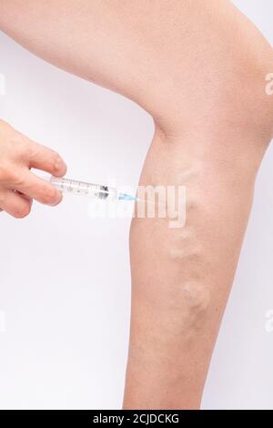 traitement varices, injection dans une jambe douloureuse. Banque D'Images