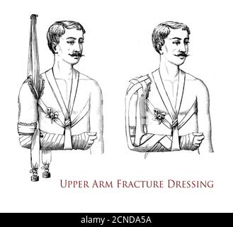 Santé et médecine: Dessin expliquant comment réaliser un pansement de fracture de bras supérieur, illustration vintage Banque D'Images