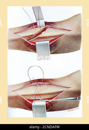 Santé et médecine: Dessin expliquant comment réaliser une suture osseuse pour un tibia fracturé, couleur vintage illustration Banque D'Images