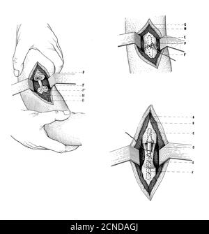 Santé, médecine et chirurgie: Dessin expliquant comment effectuer un clouage central de la partie supérieure du bras, illustration vintage Banque D'Images