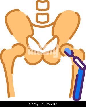 Icône de couleur plate arthroplastie. Implant de remplacement de la hanche installé dans l'os du bassin. Inscrivez-vous pour accéder à la page Web, à l'application mobile, au bouton et au logo. Vecteur isolé Illustration de Vecteur