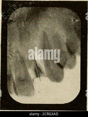 . Radiographie élémentaire et dentaire / par Howard Riley Raper . Figure 433. Identique à FIE. 432. Radiographie notFie. Al. Le fil semble avoir un canal folliculaire déformé. Voir le fil passant par la partie supérieure latérale. Radiographe déformé. Côté de la racine vers la partie distale. Faire diriger le heen à travers la dent à un angle différent (flèche n° 3,Fig. 436) et le contour des racines est relativement distinct. Lorsque les rayons X passent à travers la dent comme indi-Tifl. 436. Cated par les flèches 1 et 2, Fig. 436, le contour des racines sera plus ou moins indistinct; lorsque le rayspass droit à travers la dent, comme l'indique Banque D'Images