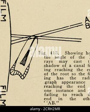 . Radiographie élémentaire et dentaire / par Howard Riley Raper . CANAL BUCCAL LIN61/AL CANAL V *2. Figure 413. Montrant l'angle des rayons X peut projeter le fard à paupières d'un remplissage de canal atteignant l'extrémité de la racine de sorte que le remplissage a l'aspect radiographe d'atteindre l'instance de fin inone et de offenser pour atteindre l'extrémité dans l'autre AB. Banque D'Images