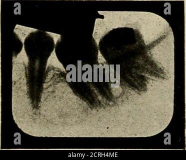 . Radiographie élémentaire et dentaire / par Howard Riley Raper . Figure 39U. Un périapicalspace exceptionnellement grand à l'apex des racines de la molaire inférieure; apparence semblable à celle d'un très petit abcès. Figure 400. Très petit abcès aux apex des rootsdu tiers molaire inférieur; aspect semblable à celui de l'espace périapical grand.. Banque D'Images