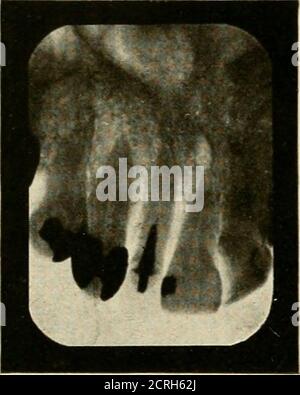 . Radiographie élémentaire et dentaire / par Howard Riley Raper . Figure 390. Le foramen mental à l'apex de la seconde bicuspide inférieure, ayant l'apparition de la cavité d'abcès. 364 LES plaques DE L'ANNEXE sont meilleures que les films pour différencier les fora-hommes mentaux d'une cavité d'abcès parce que les ombres radiographiques sur eux sont sans cesse susceptibles d'être déformées et parce qu'ils prennent dans un champ plus grand d'observation. Dans une plaque on peut voir à la fois le foramen mental et la cavité de l'abcès si on existe. Si un point ayant l'apparence d'une cavité d'abscisse est observé à l'apex d'un bicuspide inférieur et du Banque D'Images