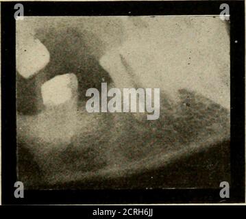 . Radiographie élémentaire et dentaire / par Howard Riley Raper . Fig. OJL*. Le foramen mental en dessous et entre les apex des racines des bicus-pids inférieurs. (Radiographie de Cole et Beeler, Indianapolis.). Figure 390. Le foramen mental à l'apex de la seconde bicuspide inférieure, ayant l'apparition de la cavité d'abcès. 364 LES plaques DE L'ANNEXE sont meilleures que les films pour différencier les fora-hommes mentaux d'une cavité d'abcès parce que les ombres radiographiques sur eux sont sans cesse susceptibles d'être déformées et parce qu'ils prennent dans un champ plus grand d'observation. Dans une plaque on peut voir les deux mental pour Banque D'Images