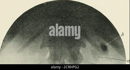 . Radiographie, thérapies à rayons X et thérapie radium . tance de ce type, où une grande ombre est vue dans le bassin du rein, qui pourrait facilement avoir été diagnostiquée comme une grande pierre. Une deuxième radiographie, prise deux jours plus tard après la purge sans fin, montre la masse plus basse dans le côlon. Le point qui a donné lieu à un diagnostic de f secalmatière était la condition de charge du colonover de la région Kid-ney opposée. (2) la bodiesin étrangère dans l'intestin peut être confondue avec cal-culus. (3) les mésentéricines androcalcifiées sont des antherelement conduisant à la toerreur dans le diagnostic de l'urinarydiagnostic. (4) le cas de l'étranger b Banque D'Images