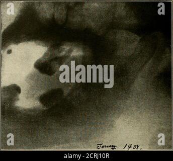 . Radiographie élémentaire et dentaire / par Howard Riley Raper . rig. 281. Les flèches pointent vers une fracture de la mâchoire inférieure juste derrière le second bicus-pid. Le côté opposé de la même mâchoire a été radiographié sur la Fig. 280.- (radiographie grossièrement retouchée; (radiographie de Cole et de Raper.) 244 RADIOGRAPHIE DENTAIRE. Figure 282, excellente radiographie de l'articulation temporo-mandibuiar. Fabriqué à partir d'un sujet de vie. (Radiographie de Tousey, de New York.) Cas: Dislocation du condyle à partir de la somme. 2$3 et 2$4. fosse aux glénoïdes. Figure 283 montre la condyle A antérieure à l'éminentia articulaire B. Fig. Banque D'Images