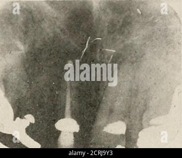 . Interprétation des roentogrammes dentaires et maxillaires . Figure 214. Fig. 215. Banque D'Images