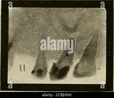 . Radiographie élémentaire et dentaire / par Howard Riley Raper . vedconsidérable travail et souci de la part de l'opérateur. La dent est probablement un deuxième molaire avancé à la place d'un molaire extrtedfirst, à en juger par la façon dont il est pourtiré et par le fait qu'il n'a qu'un seul canal. Ce cas était entre les mains de l'un des plus Tifl. 167. Opérateurs experts à Indianapolis. La première bicuspide inférieure avait été dévitalisée, et la pulpe enlevée, i/4 RADIOGRAPHIE DENTAIRE, mais la dent demeurait douloureuse. La radiographie a eu recours pour apprendre, ifpossible, la cause - du peric persistant Banque D'Images