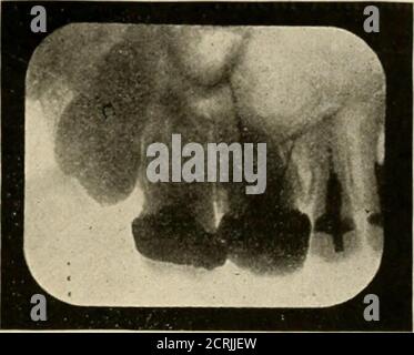 . Radiographie élémentaire et dentaire / par Howard Riley Raper . Fig. k.o. Figure 161. Fig. 1(50. Troisième molaire supérieur impacté.Fig. 161. Molaire supérieur touché. Noter la différence de position de la dent de frappe illustrée dans ce cas et sur la Fig. 160. Banque D'Images