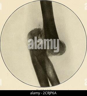 . Un atlas radiographique des changements pathologiques des os et des articulations . PLAQUE LXVIII. — i86 — PLAQUE LXIX. DISLOCATION VERS L'ARRIÈRE ET VERS LE HAUT DES DEUX OS DE LA VUE AVANT-BRAS-LATÉRALE—FRACTURE DE L'OLÉCRÂNE—SAMECASE COMME PLAQUE LXVIII. PLAQUE LXIX. —188 — PLAQUE LXX. LUXATION VERS LE BAS, VERS L'AVANT ET VERS L'INTÉRIEUR DE LA TÊTE DE THEHUMERUS—LUXATION ANCIENNE. La cavité de la gluténoïde est vide. Le nouveau joint peut être fabriqué de manière distincte. Banque D'Images