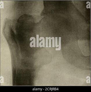 . Un atlas radiographique des changements pathologiques des os et des articulations . PLAQUE LXIV. -176- PLAQUE HxV. FRACTURE DE L'EXTRÉMITÉ SUPÉRIEURE DE L'ARBRE DU FÉMUR—LE FRACTURERUNS PAR LA LIGNE INTERTROCHANTÉRIQUE DU FÉMUR. PLAQUE LXV. 178- PLAQUE LXVI. FRACTURE DE L'ASTR(CALUS—TXINICAL DIAGNOSTIC, CONTUSION DE THEANKLE. La fracture devient immédiatement apparente lorsque la comparaison est faite avec le skiagram d'une cheville normale (plate XIII). Sans une telle assistancecette plaque est très difficile à interpréter. Banque D'Images