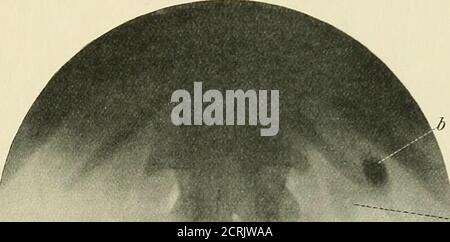 . Radiographie, thérapeutique à rayons X et thérapie radium . ance de ce type, où une grande ombre est vue dans le bassin du rein, qui pourrait facilement avoir été diagnostiquée comme une grande pierre. Une deuxième radiographie, prise au cours des deux jours suivant la purge sans fin, montre la masse plus basse dans le côlon. Le point qui a donné lieu à un diagnostic de matière faecalmatter était la condition de charge du colonover de la région kid-ney opposée. (2) la bodiesin étrangère dans l'intestin peut être confondue avec cal-culus. (3) les mésentéricines androcalcifiées sont des antherelement conduisant à la toerreur dans le diagnostic de l'urinarydiagnostic. (4) le cas de bo étranger Banque D'Images