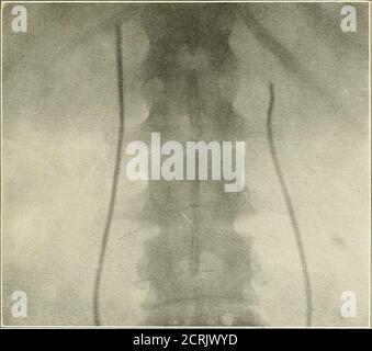 . Roentgen interprétation; un manuel pour les étudiants et les praticiens . Figure 176.—UNE glande mésentérique calcifiée suggérant une pierre dans l'uretère. Figure 177.—même cvTse que Fig. 176. Le fathetcr radiofiraphique démontre que l'ombre est bien en dehors du cours de l'uretère. Banque D'Images