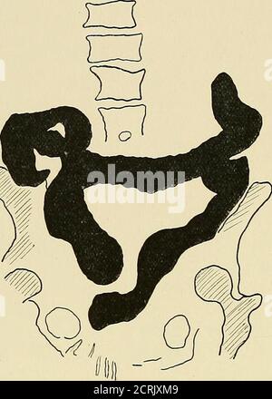 . Radiographie, radiothérapie et radium . otation et taches dans l'intestin grêle. Diagnostic : adhérences dans le voisinage de la valve iléocaecale. Examen du gros intestin le gros intestin est divisé en (1) Csécum ; (2) côlon ascendant ; (3)flexion hépatique ; (4) côlon transverse ; (5) flexion splénique ; (6) côlon descendant ; (7) flexion sigmoïde ; (8) rectum. Les relations anatomiques des parties doivent être clairement comprises. Le caecum est la partie du côlon qui se trouve sous la valve ileo-csecalvalve. Il est presque entièrement entouré par le péritoine, et, étant indépendant ymovab Banque D'Images