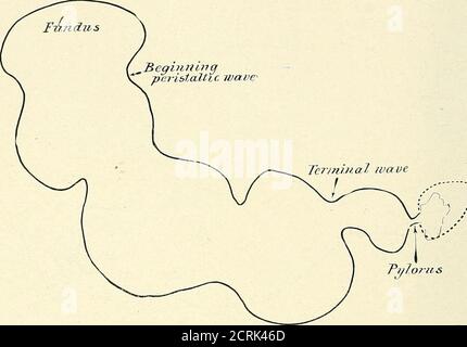 . Roentgen interprétation; un manuel pour les étudiants et les praticiens . Figure 153.—traçage, montrant le type d'ulcère duodénal. 174 TRACTUS GASTRO-INTESTINAL. Figure 154.—traçage de l'estomac, montrant le peristalsis profond et vigoureux de l'ulcère duodénal. Banque D'Images