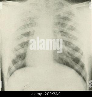 . Radio-diagnostic de l'affection pleuro-pulmonaire . Radiographie 14. OEILLET DE CUIVRE DANS LE BRONCHUSLE oeillet de cuivre avec un trou au centre se trouve dans la bronche droite, au niveau du hile contre le bord droit de l'ombre médiane. N° 1389. J. K.bronchi à droite. Homme radiographie 15ans. Dilatation de la tuberculose pulmonaire de Banque D'Images