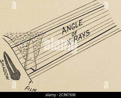 . Radiographie élémentaire et dentaire / par Howard Riley Raper . Figure SF&gt ;. La bonne pose pour faire des radiographies de la région bicuspide supérieure et molaire anda radiographie faite à partir de la pose. Figure 87. Illustration schématique de la pose vue sur la Fig. 86, montrant les rayons X frappant le film de la dent à un angle permettant d'éviter soit l'allongement, soit le raccourcissement de l'ombre sur le film. (Schéma de la drawirg après Dr Price.) 100 RADIOGRAPHIE DENTAIRE Banque D'Images