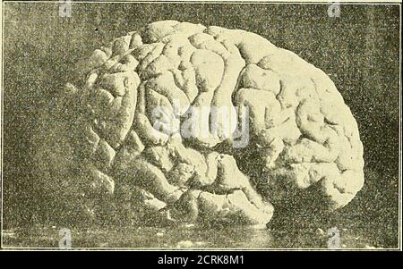 . Klinische und anatomische Untersuchungen über den Cretinismus . orizontale AST der Fissura Sylvii ist kurz. Die typische Furchungist im Scheitellappen ziemlich verwischt. Rechtungär gegliedert. Die rechteInterparietalfurche ist durch einen senlcrechten Winbungszug in ihrem Mittelstückunterbrochen, so dass sie in zwei selbständige Furchenhälften zerfällt. Die vorderePurchenhälfte mündet BEI oberflächlicher Betrachtung in die obere Schläfenfurche, ist aber bei genauer Untersuchung durch eine schmale Tiefenwindung von derselbengetrennt. Nach vorn zu schneidet dieser vordere Theil d Banque D'Images