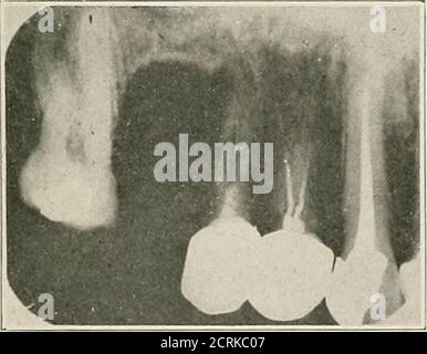 . Interprétation des roentogrammes dentaires et maxillaires . Figure 22.-C.. Banque D'Images