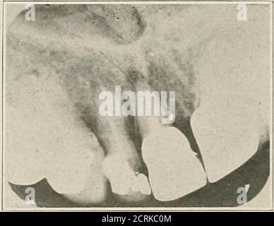 . Interprétation des roentogrammes dentaires et maxillaires . Figure 22-D. Figure 22-E. Banque D'Images